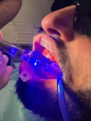 laser sbiancamento denti studio DentalSì Marcianise trattamento professionale