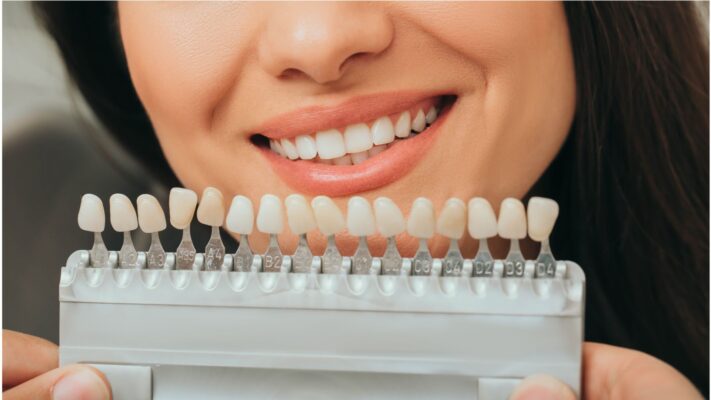 sbiancamento denti professionale studio dentistico Dental Sì Marcianise