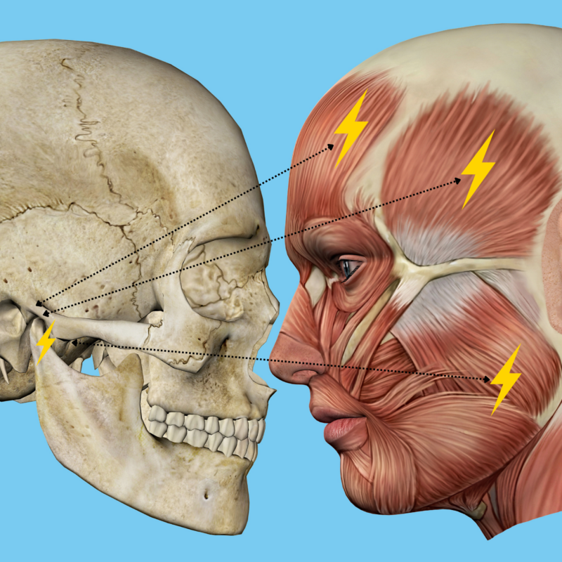 articolazione temporo-mandibolare muscoli masticatori irradiazione dolore testa collo cervicale