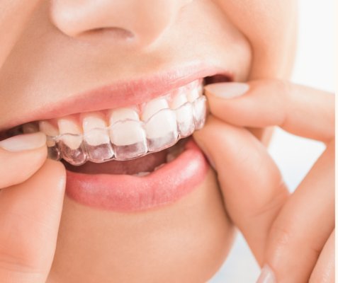 allineatori trasparenti adulti Invisalign Angel Align studio Marcianise ortodonzia