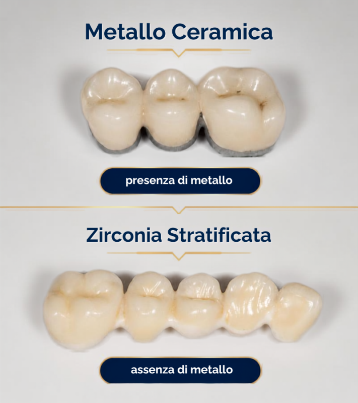 confronto Zirconia stratificata vs Metallo-Ceramica