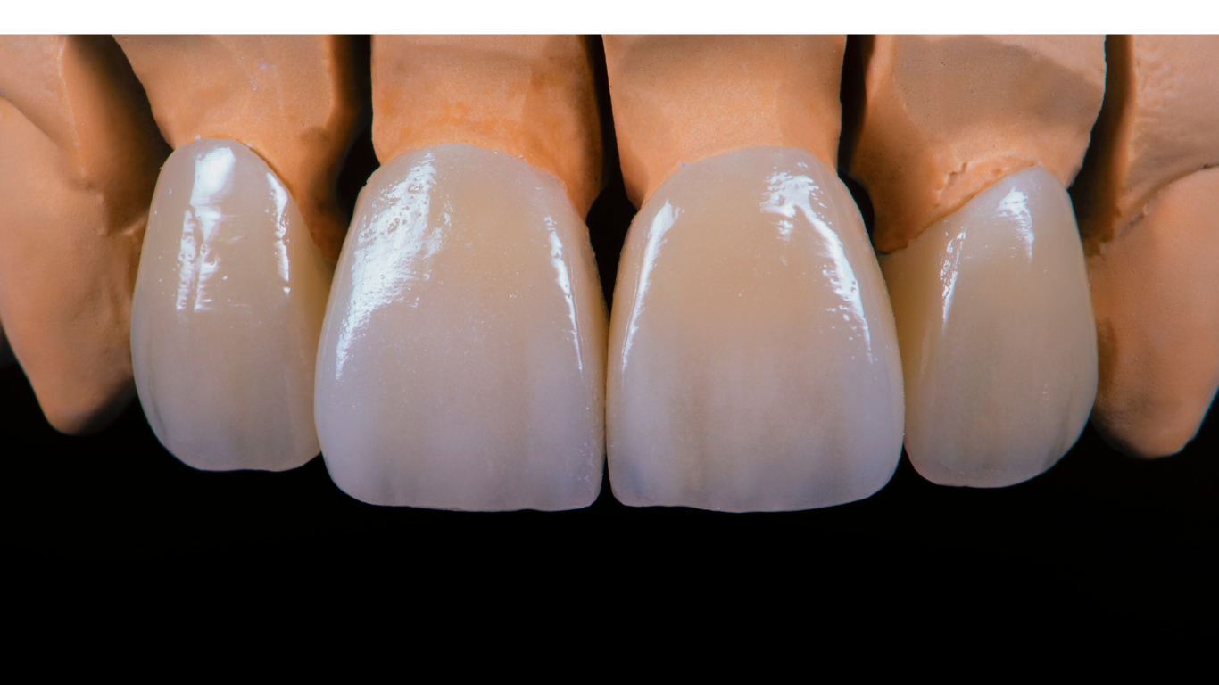 disilicato di litio corona dentale emax traslucenza naturalezza estetica