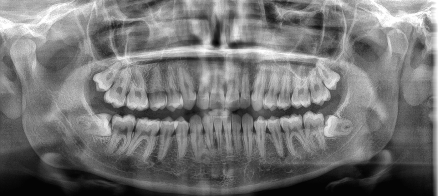 dente del giudizio semincluso valutazione estrazione TAC 3D DentalSì Marcianise Caserta